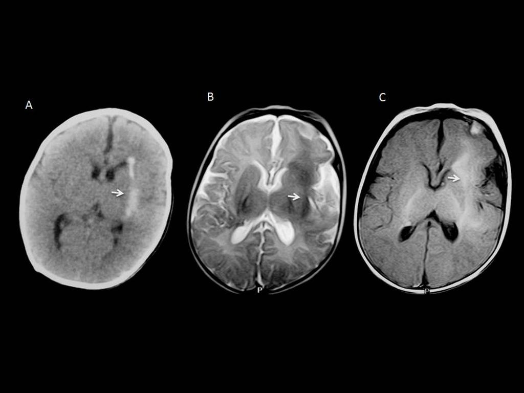 Fig 15: CT scan and MRI of a 2-year-old male patient who presents with a lesion in the white matter corresponding to the left