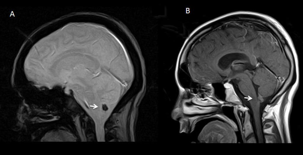Fig 16: MRI of a 16-year-old male patient who presents with a hypointense image on gradient-echo at the bottom of the fourth