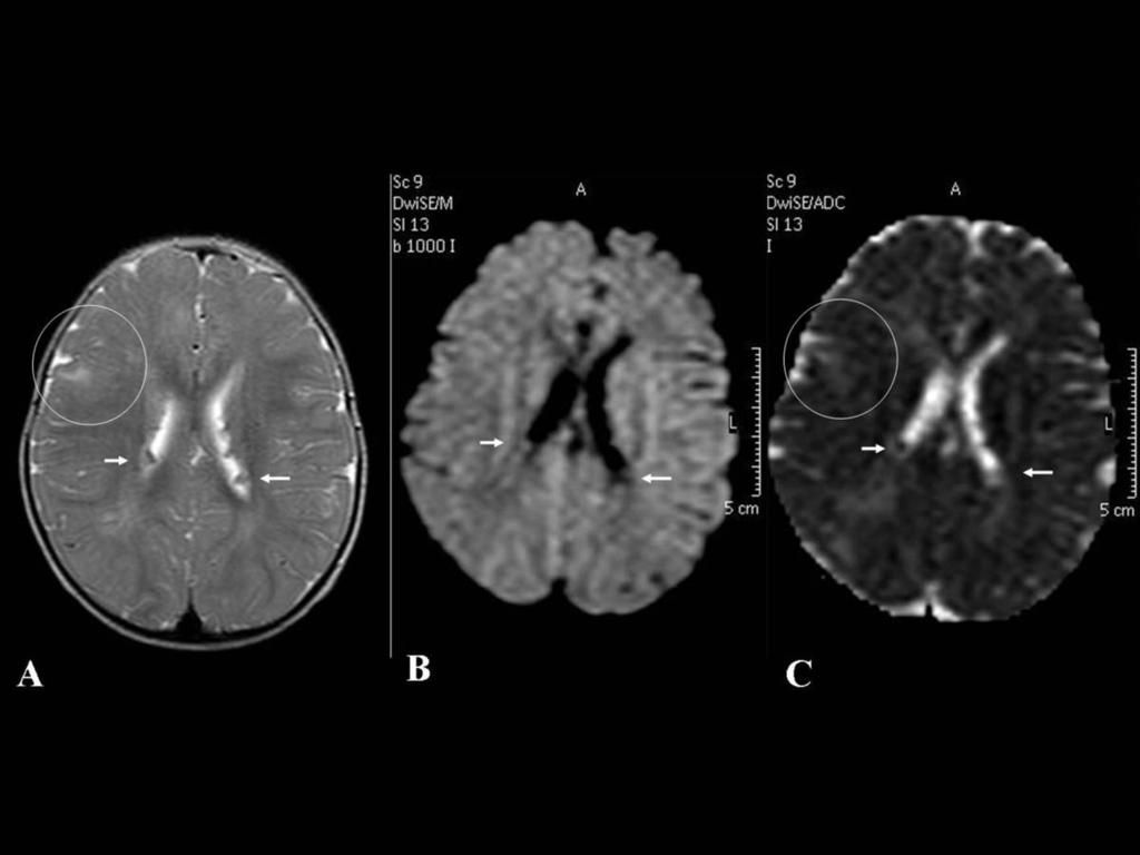 Fig 17: Axial T2-sequence (A) of a 1-year-old male patient, who presents with subependymal hamartomas in both lateral ventricules (white arrows), and cortical tubers (circle) In the diffusion, in DWI