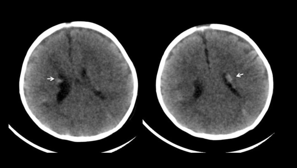 Fig 2: CT scan of a 2-month-old male patient who had seizures in his first month of life