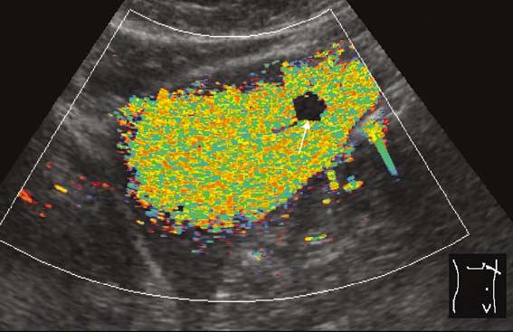 homogeneous color pixel enhancement of the liver. A Interobserver agreement during baseline imaging was poor, with a weighted κ value of 0.579 ± 0.038 and a simple κ value of 0.382 ± 0.086.