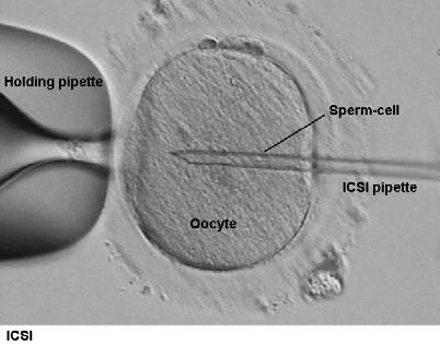 Fertilisation with ICSI (Intra Cytoplasmic Sperm Injection, mikroinjection, mikroinsemination ).