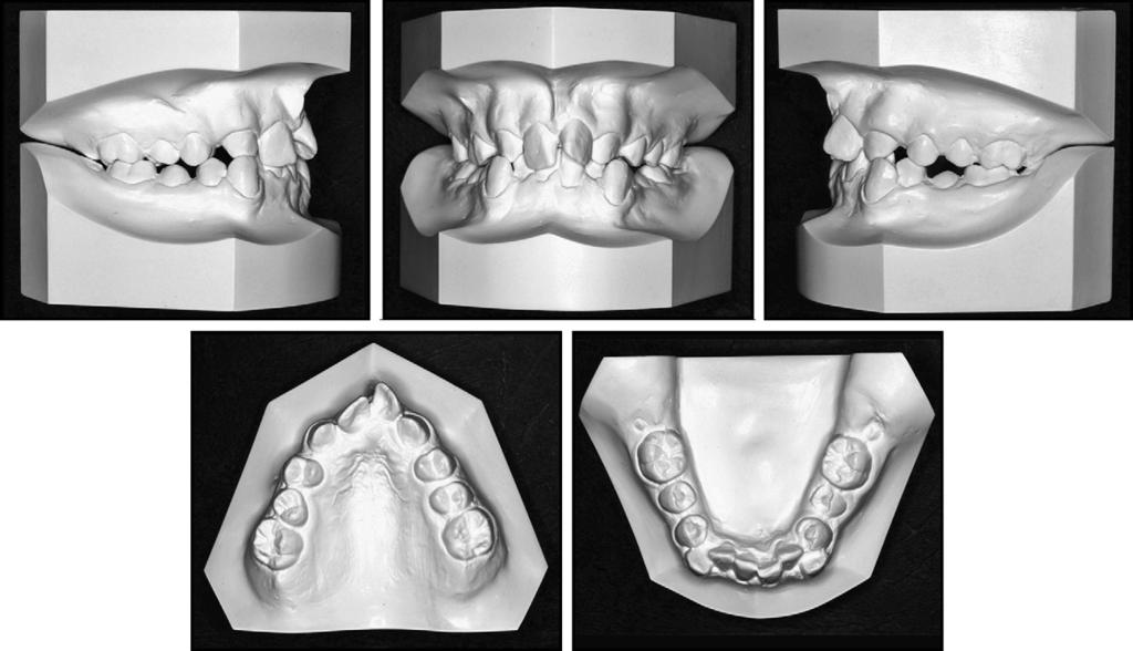 692 Al-Anezi Fig 2. Pretreatment models. involving the maxillary canines, (6) close the maxillary spacing, (7) substitute the maxillary canines as lateral incisors, and (8) retain.