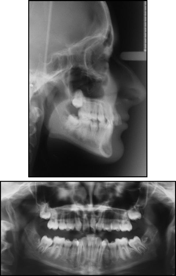 Al-Anezi 693 Fig 4. Pretreatment cephalometric tracing. Fig 3. Pretreatment dental panoramic tomograph and lateral cephalometirc radiograph. closure in the mandibular right quadrant was slow.