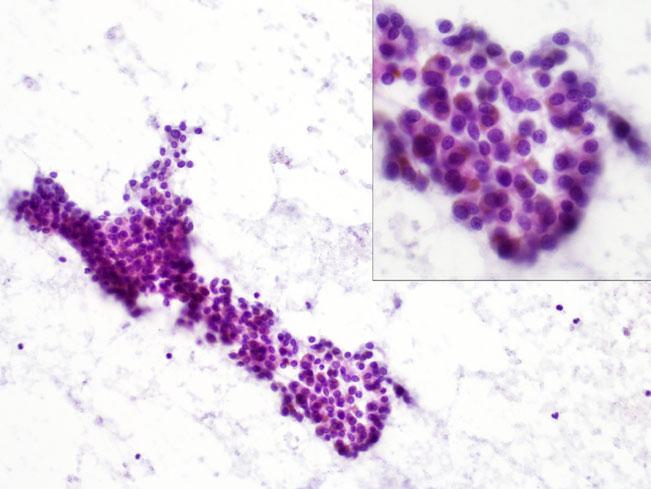 HSSJ Author's personal copy Fig. 2. Image-guided fine needle aspiration biopsy from case 1.