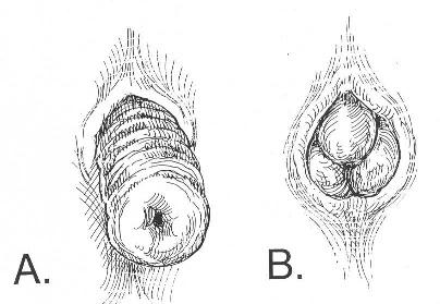 Rectal Prolapse: A 10-Year Experience Figure 2. Physical examination. A. Concentric folds of prolapsed rectum. B. Radial folds of hemorrhoids (mucosal prolapse). (From Beck DE, Whitlow CB.