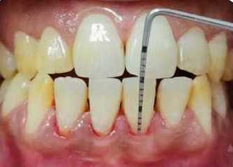[3] Out of several procedures described in the literature for the purpose of recession coverage, it is the bridge flap which serves dual function of increasing the width of attached gingiva as well