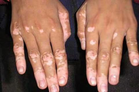 Overview Most common skin depigmentation disorder.