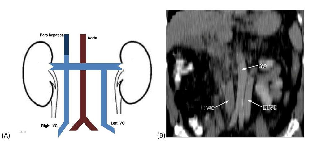 posterior segment of the circumaortic LRV) is compressed by the aorta - giving rise to ## the posterior nutcracker phenomenon. Retroaortic Left Renal Vein (fig.