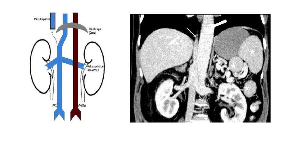 Fig. 3: Azygos continuation of IVC.