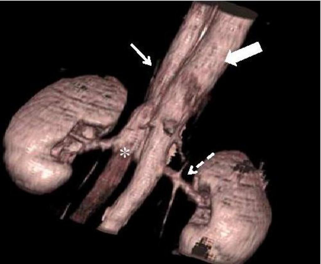 Fig. 4: 3-D reconstrcuted CT-image of the same patient as in fig 8, shows azygos continuation (thin arrow) of IVC, associated with retroaortic left renal