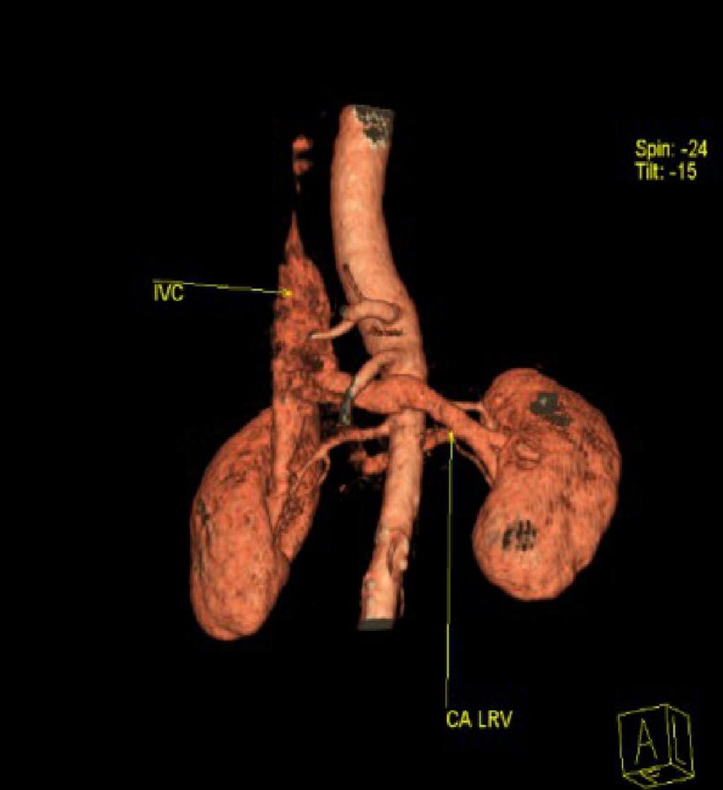 Fig. 8: 3-D reconstructed CT-images in another patient with circumaortic left renal