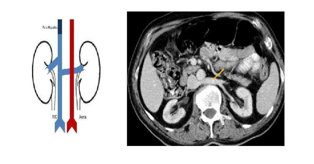 Fig. 9: Single retroaortic left renal vein, as shown in the diagram [modified from reference 1].