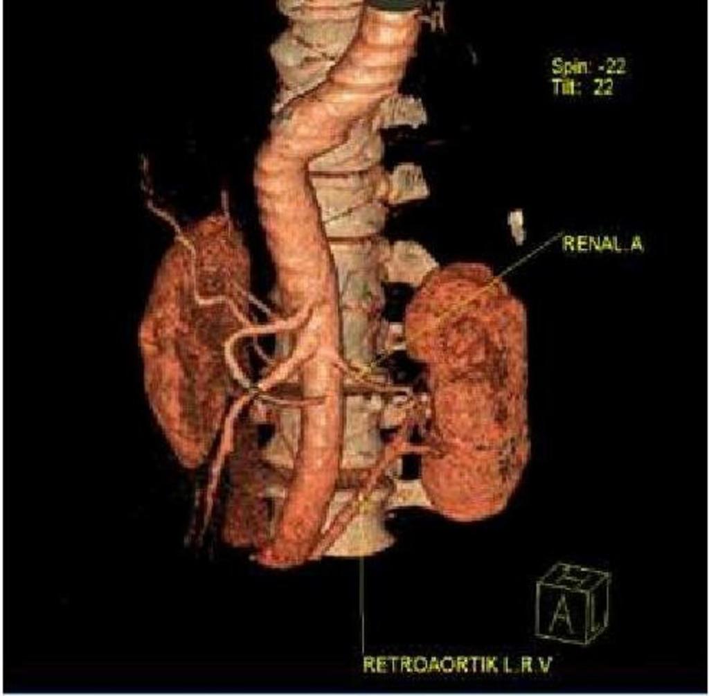 Fig. 10: 3-D reconstructed CT-image in a 70-year-old man showing a single left renal vein descending to cross