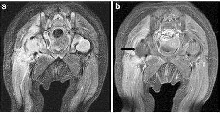 1 kuu vanune artriidi kahtlusel a STIR; paremal väljendunud periartikulaarsete kudede signaalimuutus (turse), kuid epifüüsi piirkond on