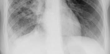 If so, what form of TB does the radiology suggest?