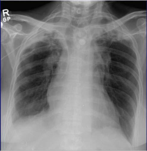 Abnormal Normal Prior reactivation tuberculosis Upper lobe scarring Volume loss Retraction of hila superiorly Band-like (linear)
