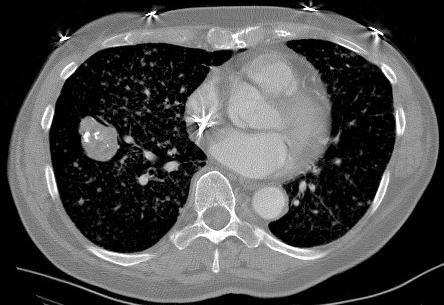 Irregular calcification: adenocarcinoma Role of CT scan for nodules 1.