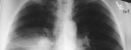 Primary tuberculosis Difficult radiologic diagnosis Mimics