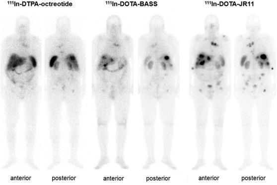 IMAGING WITH SOMATOSTATIN RECEPTOR ANTAGONISTS Comparison of 111In-DTPA-octreotide scintigraphy (SSTR2 agonist), 111In-DOTA-BASS scintigraphy (SSTR2 antagonist), and 111In-DOTA-JR11 scintigraphy