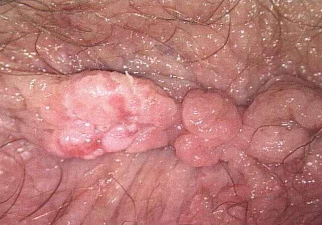 Peri-anal and Intra-anal Warts should,
