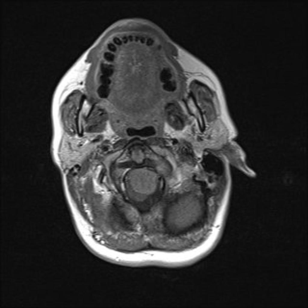 Fig. 8: Contrast enhanced axial T1-WI shows a homogenous enhancement of the