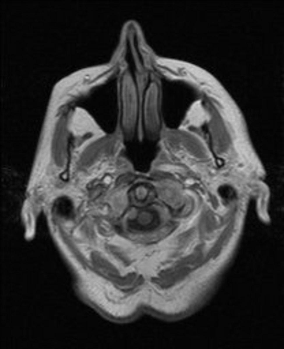 Fig. 10: Axial contrast-enhanced T1-WI shows a small