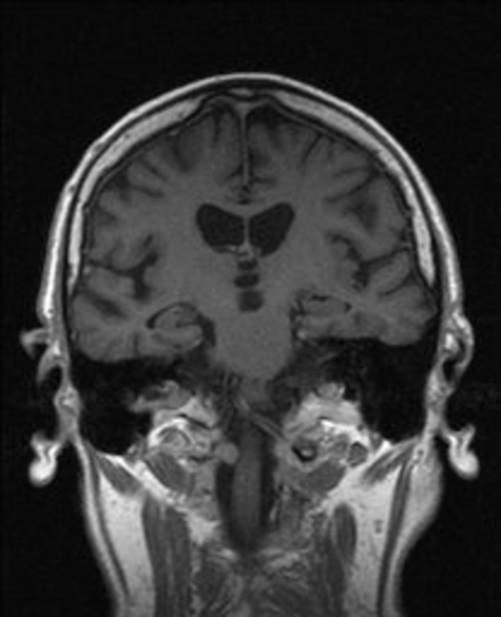 Fig. 11: Coronal contrast-enhanced T1-WI shows a small