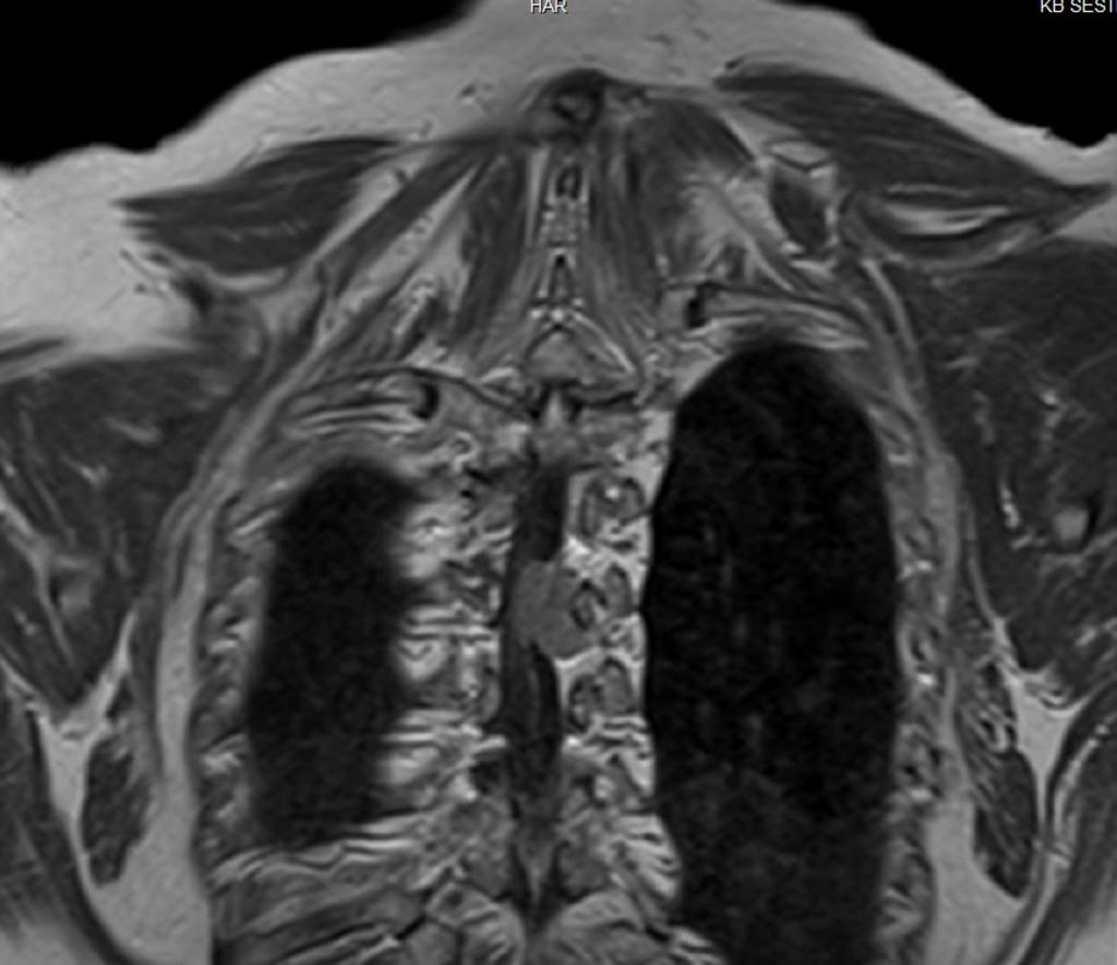 Fig. 14: Coronal contrast-enhanced T1-WI shows a thoracic spine