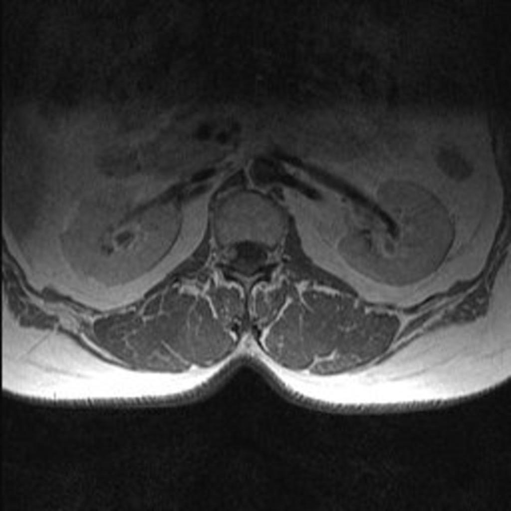 Fig. 19: Axial contrast-enhanced T1-WI shows a homogenous enhancement