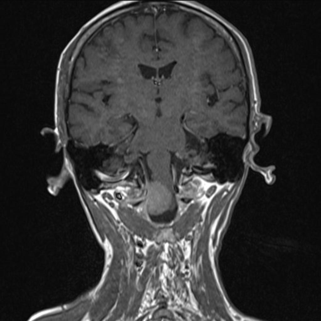 Fig. 4: Contrast-enhanced coronal T1-WI shows a homogenously enhancing meningioma of