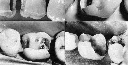 However, the lesion at the mesial of the adjacent upper lateral incisor has just involved the incisal corner and is therefore a Site 2, Size 3 lesion (#2.3). Fig. 9.
