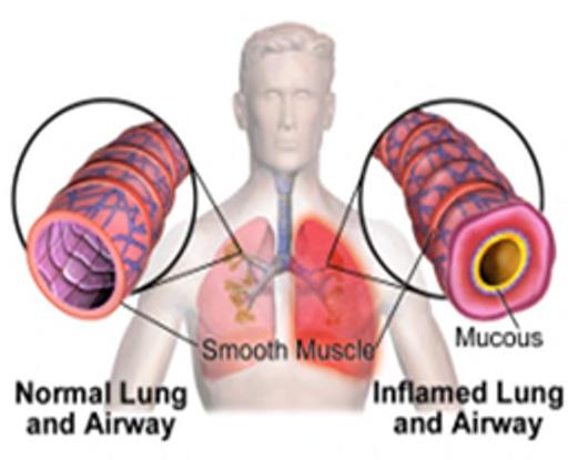 Airway inflammation is major cause of asthma FeNO measurement provides objective measure