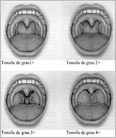 Tonsillar