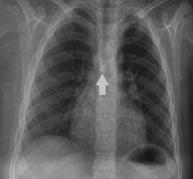 es and Lower Airway Problems Lower Airway Problems: Tracheal Stenosis 38 y.o. obese, Male # L1, Laminectomy + Fixation, Prone Remote tracheal resection for stenosis Inspiratory & Expiratory Stridor?