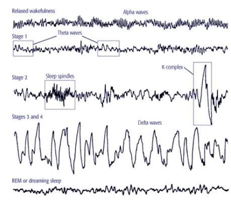 Figure 4-5: EEG during wakefulness and different stages of sleep [https://www.slideshare.net/anshukg/sleep-53787522]. Spikes and sharp waves (SSWs).