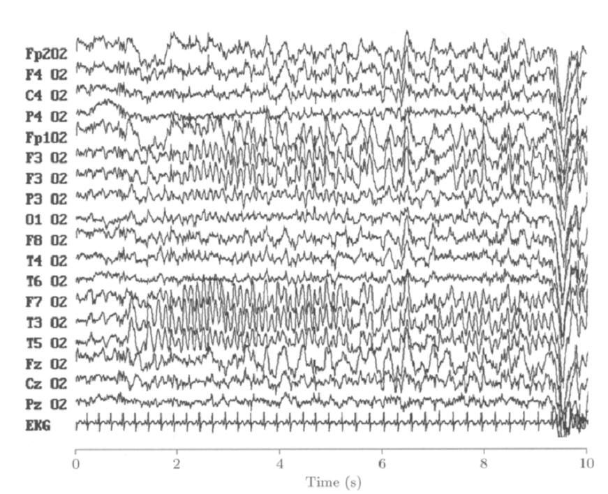 Figure 4-7: A multichannel EEG showing the onset of an epileptic seizure, occur ring after the first second. The onset is characterized by an increase in amplitude and a change in spectral content.