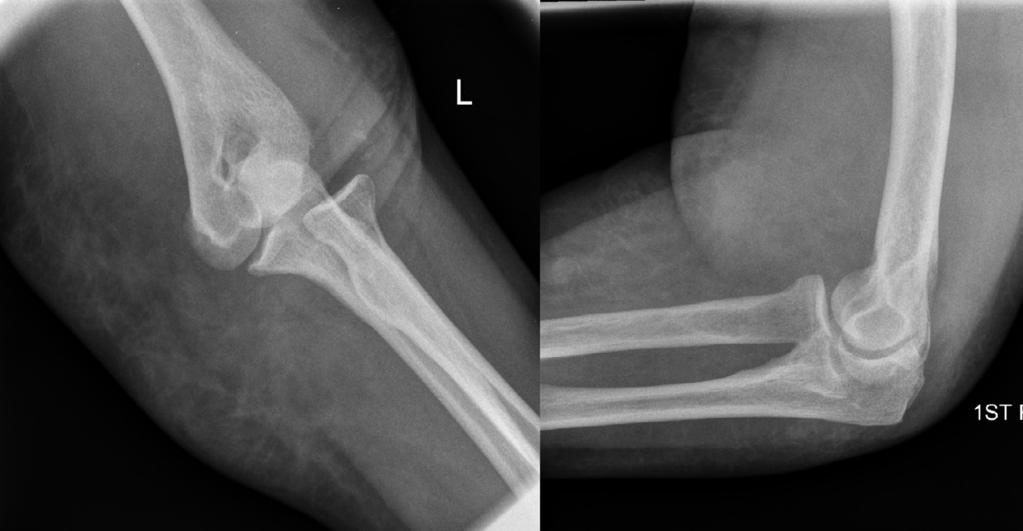 The surgery was performed under regional anaesthetic. The elbow was reduced and stressed to assess the competence of the collateral ligaments.