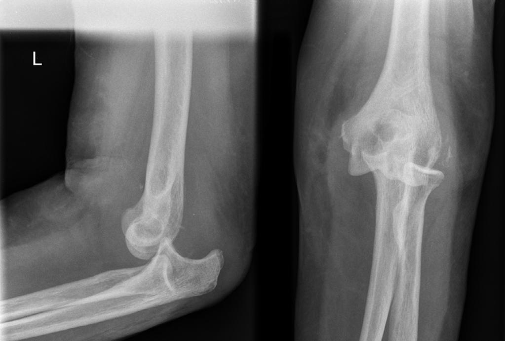 ligamentous disruption was severe enough that the joint congruence could not be maintained with simple closed reduction and elbow flexion beyond 90.