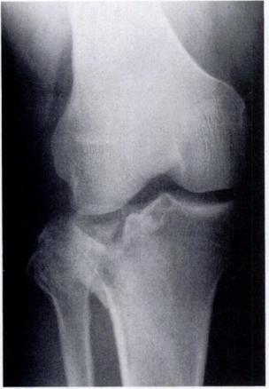 plateau fracture in a 140 kg man.