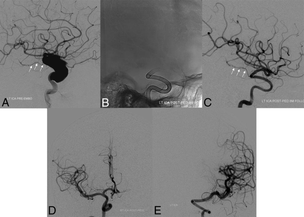 contributing factor for incomplete closure of aneurysms treated with the PED. FIG 1.