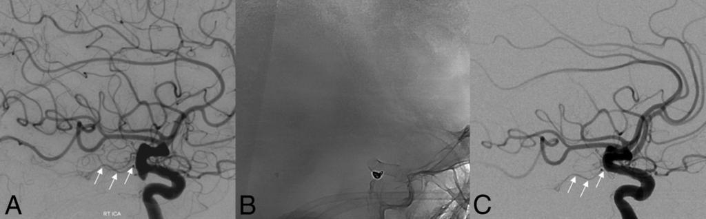 In an initial posttreatment follow-up angiogram after placement of a PED, unsubtracted mask (B) and arterial phase DSA in a lateral projection (C) demonstrate complete occlusion of the aneurysm with