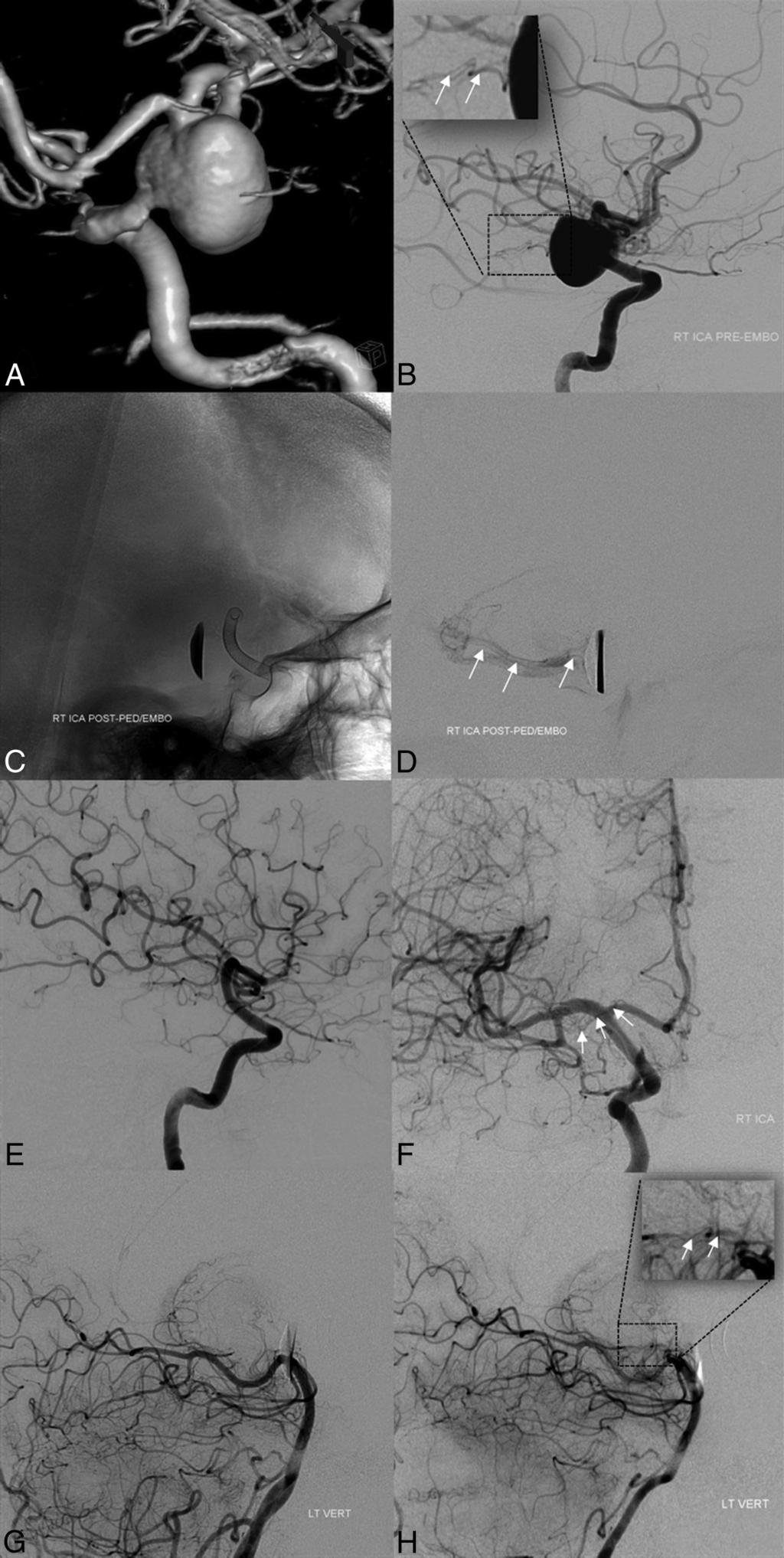 FIG 3. Baseline pretreatment 3D-DSA (A) and lateral projection DSA (B) demonstrating a large anterior choroidal artery aneurysm.