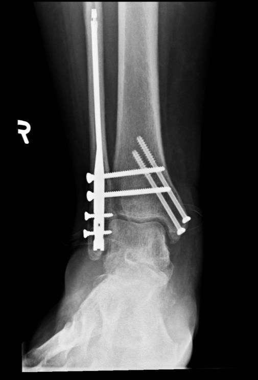 Anatomic Structures at Risk When Utilizing an Intramedullary Nail for Distal Fibular