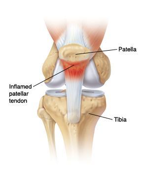Common causes of knee pain include: 1. Patella tendonitis.