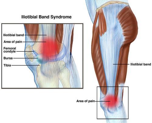 A thick band of tissue (ITB) runs from your buttock down along the outside of your thigh and attaches to the side of your shin bone (tibia).