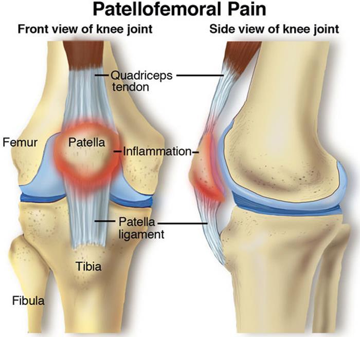 5. Patellofemoral Pain Syndrome. The patella tracks in a groove as your knee is bent and straightened.