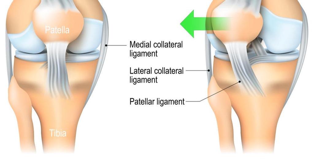 Pain is felt in or around the front of the knee as you bend and straighten your leg often with the kneecap producing a clicking or grinding feeling.
