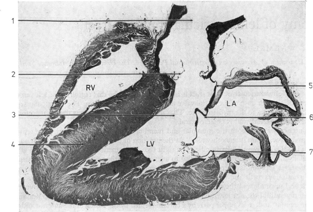 4~~~~~~~~~~~~~~~~ 264 Robert Wahnsley RV~. 2 ---- 7,,J, J 3 Fig. 1 Section through the heart of a 50-year-old man, to show both the inflow and outflow tracts of left ventricle.