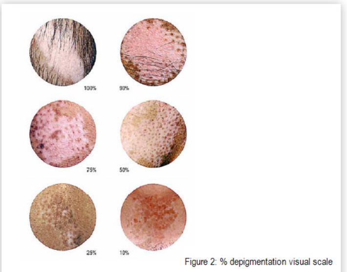 CLINICAL STUDY MATERIALS AND METHODS In vivo evaluation: VASI (Vitiligo Area Scoring Index) assessment Clinical evaluation of skin condition in 10-point analogues scale (skin elasticity and dryness)